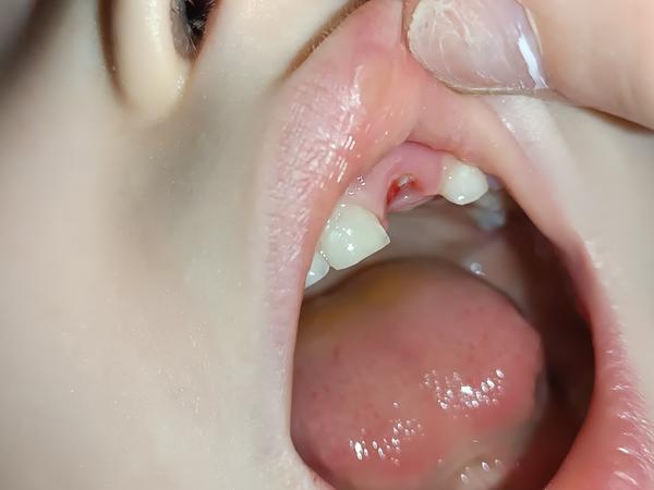 Zůstává kousek mléčného zubu nebo roste nový?