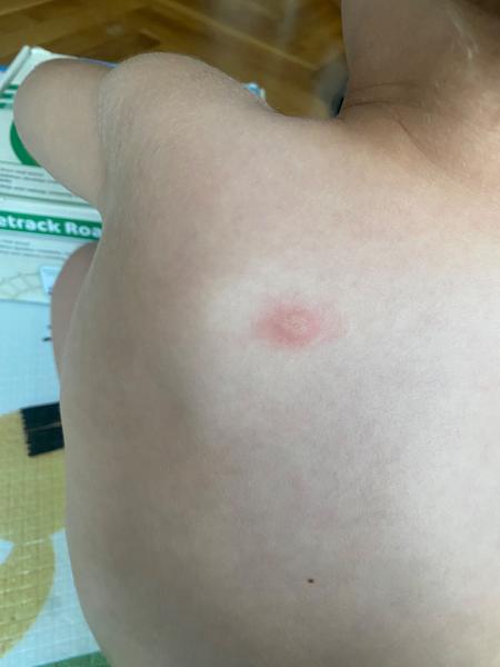 Pupen na zádech u dítěte. Čím to může být?