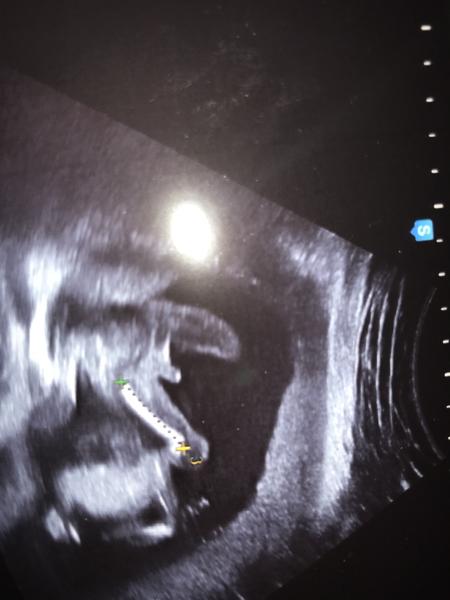 Pohlaví dvojčat, co myslíte?