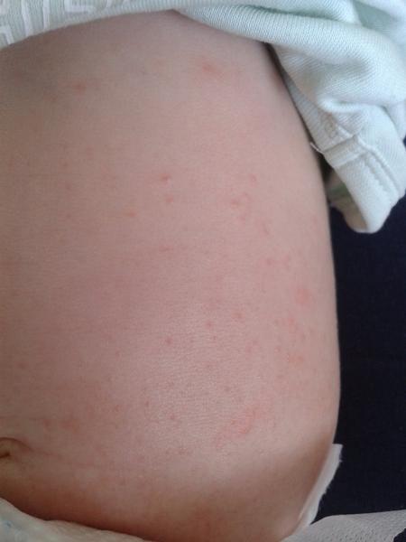 Vyrážka, z čeho to může být?