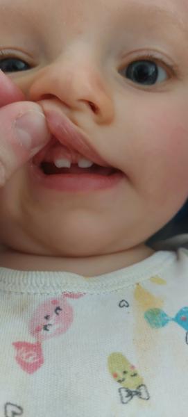 Kousek vyraženého zoubku u dítěte. Jak postupovat?