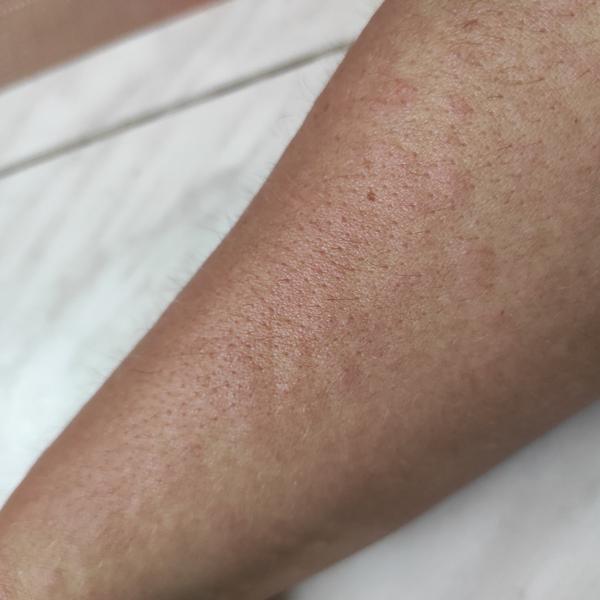 Může mít dospělý pátou nemoc? Zkušenosti a příznaky