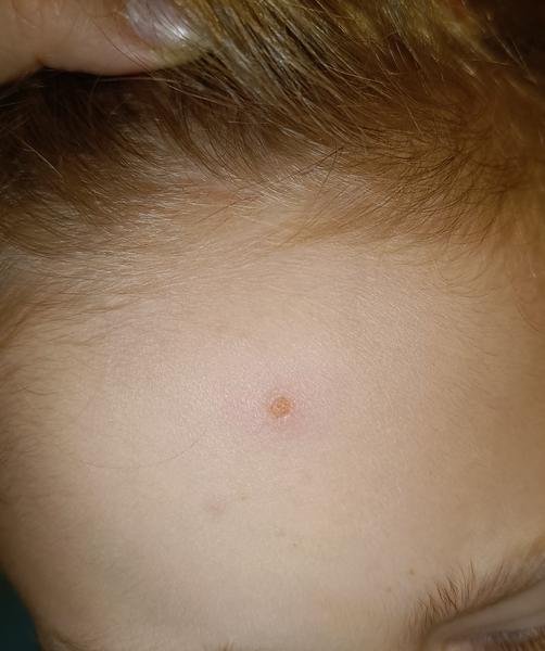 Jsou pupínky na těle příznakem neštovic?