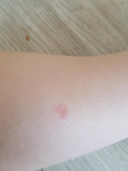 Může to být alergie na jídlo?