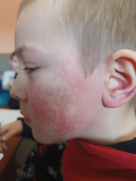 Co způsobuje vyrážku? Jak ji správně léčit?