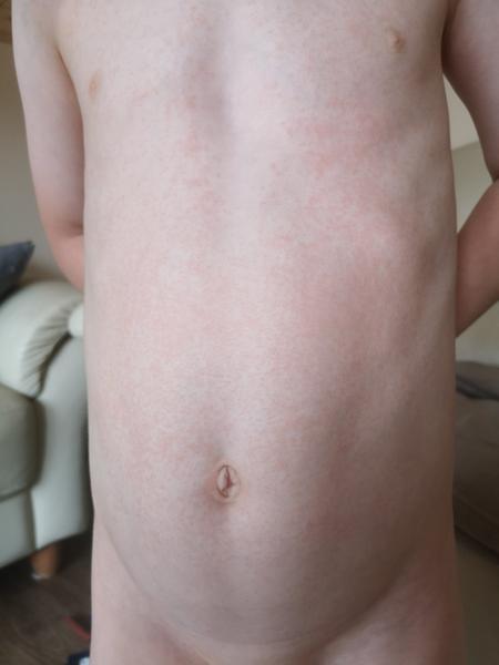 Vyrážka bez teplot. Mohlo by se jednat o potravinovou alergii?