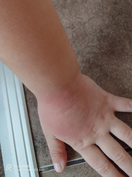 Co způsobuje vyrážku doprovázenou vysokou teplotou u dětí?