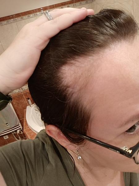 Vypadávání vlasů po porodu: Jak řešit šílené kouty?