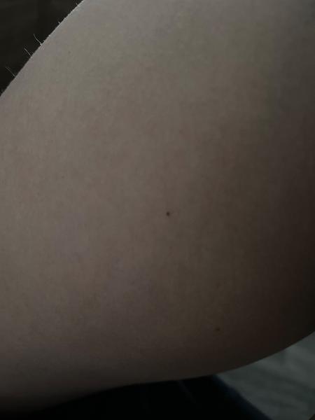 Červené tečky na kůži. Jsou to petechie nebo hemangiom?