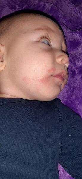 Jak řešit vyrážku a suchou pokožku u čtyřměsíčního miminka?