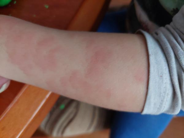 Kožní vyrážka u malého dítěte: Co by to mohlo být?