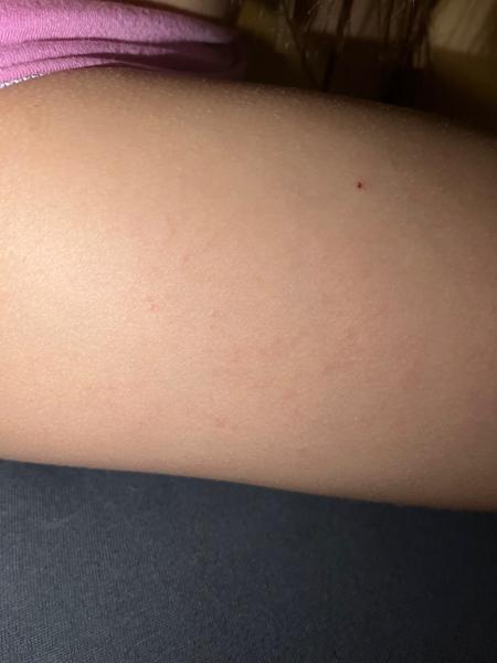 Možné příčiny svědivé vyrážky u dětí?