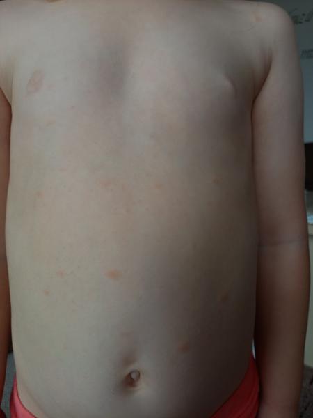 Fleky na těle u dcery. Co může být příčinou?