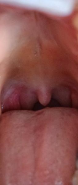 Jak řešit bolest mandlí s bílými tečkami?