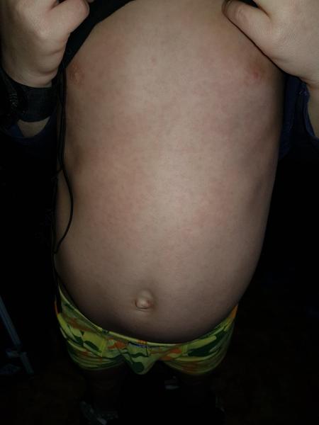 Je ta vyrážka spála nebo něco jiného?