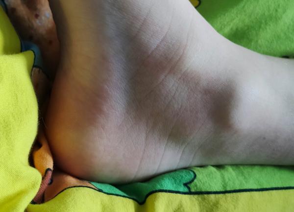 Co způsobuje vyrážku po podání léků jako Panadol a Nurofen?