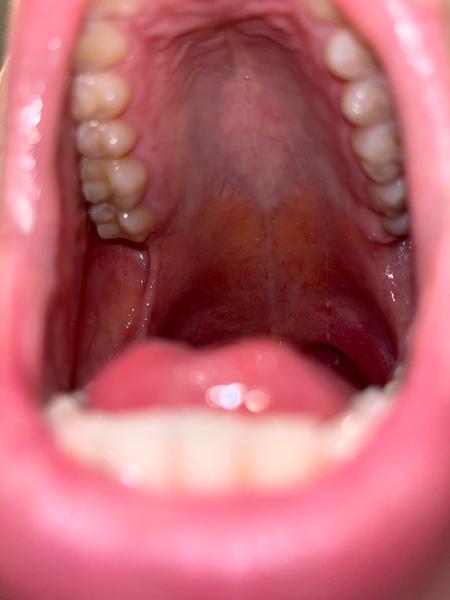 Bílé patro a slabost. Ucpané slinné žlázy?