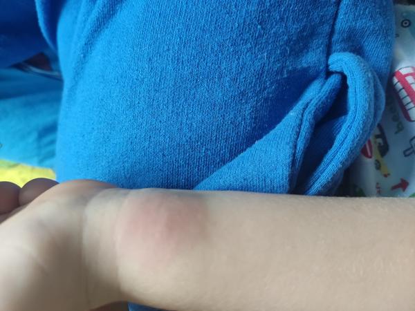 Alergie. Může to být horší? Kdy fleky zmizí?