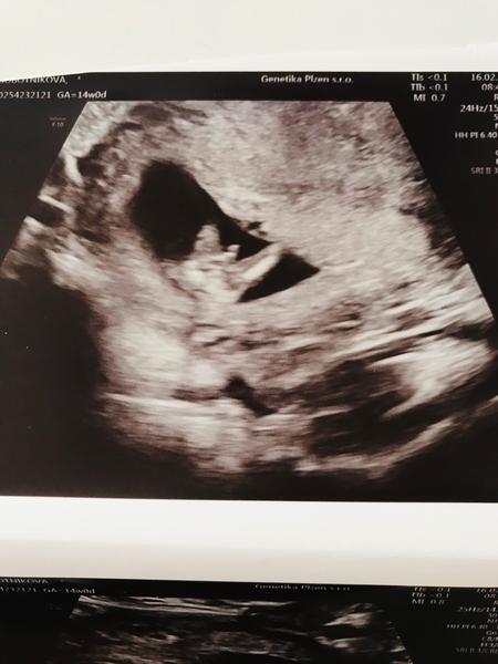 Je to kluk? Zkušenosti a názory na ultrazvuková fota.