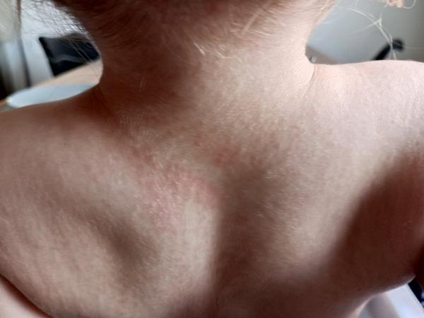 Neznámé tečky na těle dítěte: Jak řešit?