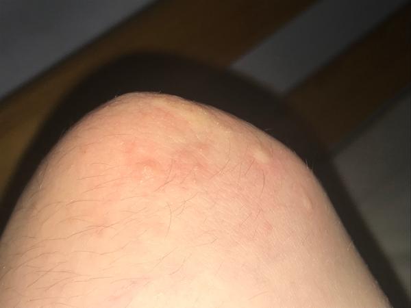 Svědivá kožní vyrážka: Co může být příčinou?