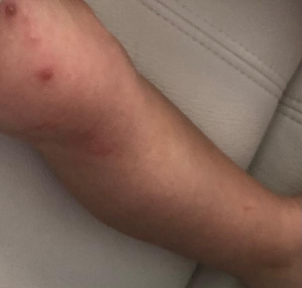 Neštovice nebo jen komáří štípnutí na stehnech?