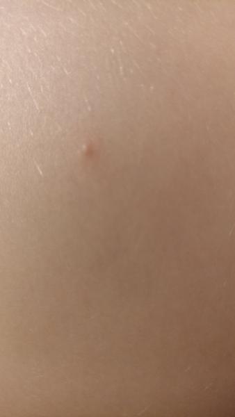 Rozpoznání vyrážky u dětí: Neštovice nebo štípnutí hmyzem?