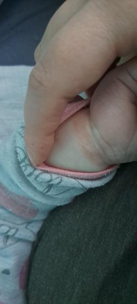 Červené fleky. Kvasinka nebo atopický ekzém?