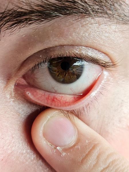 Bolestivé tečky v oku. Co to může být?