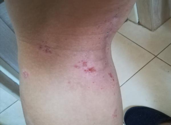 Ekzém. Jakou stravu omezit a čím natírat?