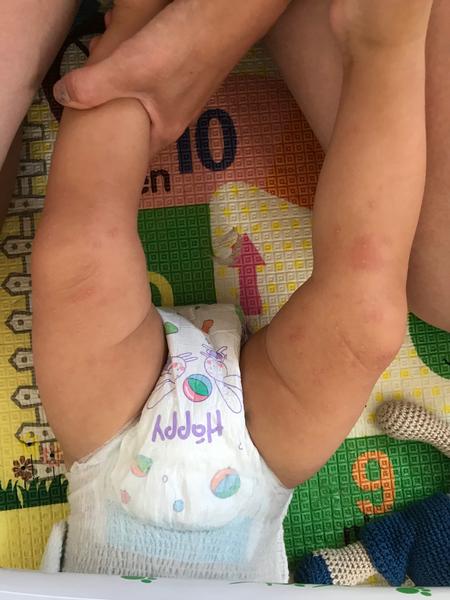 Vyrážka na nozičkách ročního chlapečka. O jakou vyrážku by se mohlo jednat?