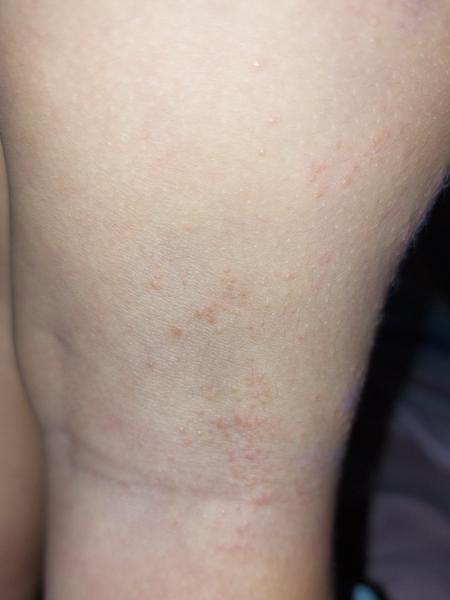 Vyrážka. Poradíte, prosím?