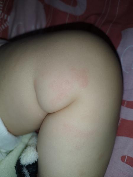 Lepek způsobuje znovu se objevující flíčky u dětí?