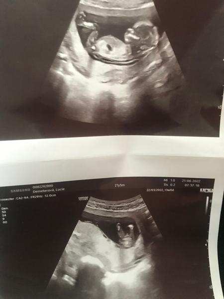 13. týden těhotenství. Lze z těchto fotek určit pohlaví?