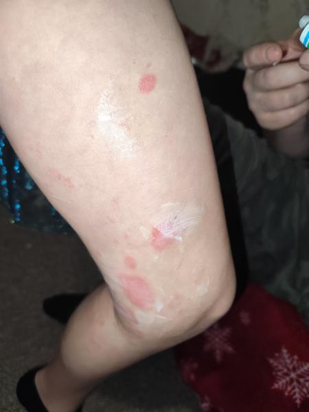 Ekzém nebo alergická reakce u dětí? Co způsobuje svědění?