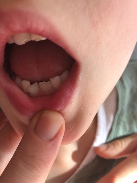 Je třeba odstranit mléčné dvojky?