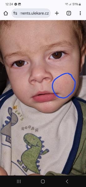 Výraznější cévičky a červený flíček na tváři: Co to je?