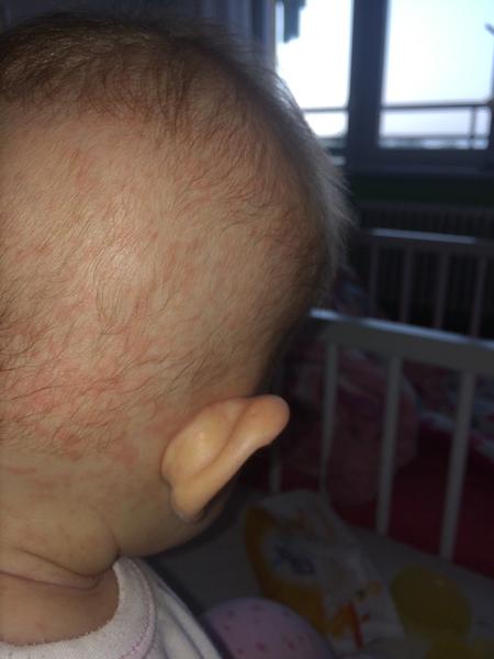 Vyrážka - je to alergie nebo potničky? 