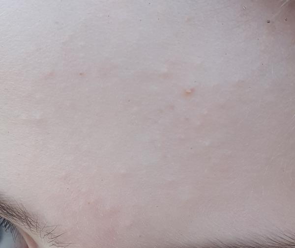 Jak řešit krupičku na čele u dětí?