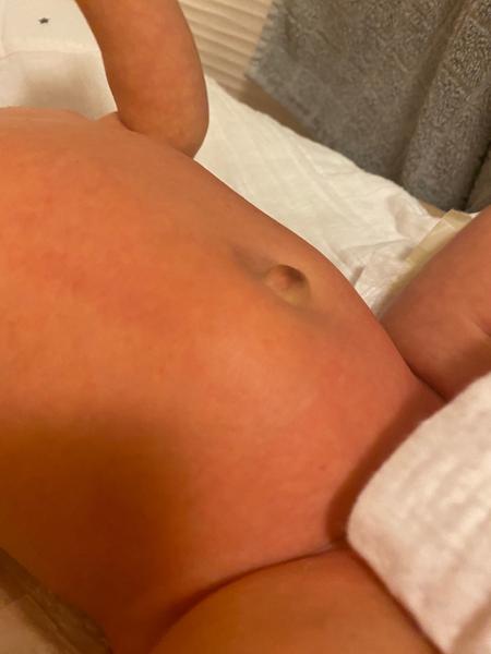 Pupeční kýla. Mohla by to být?