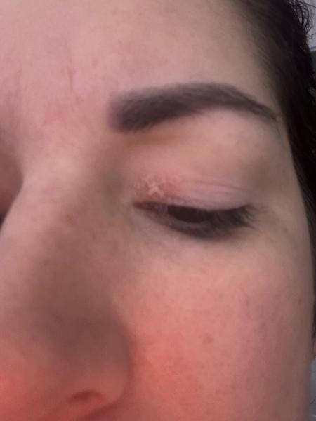 Zarudnutí a svědění. Může to být začátkem lupénky?