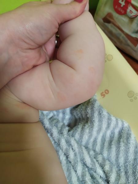 Kožní ekzém, kvasinka nebo plíseň. Co by to mohlo být?