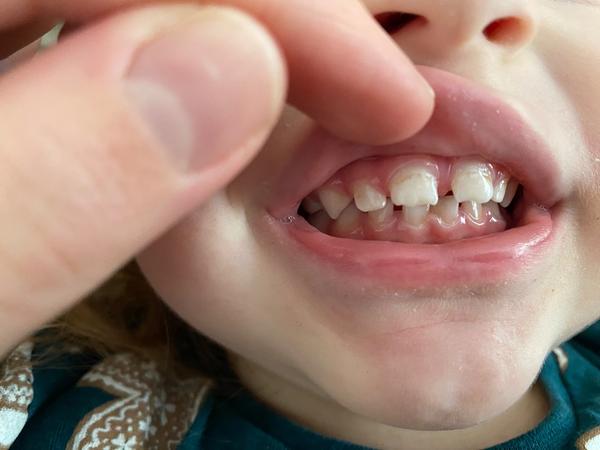 Hnědý pruh na mléčných zubech. Jaké jsou možné příčiny?