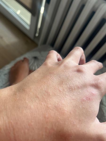 Jak rozeznat svrab od jiných kožních problémů?