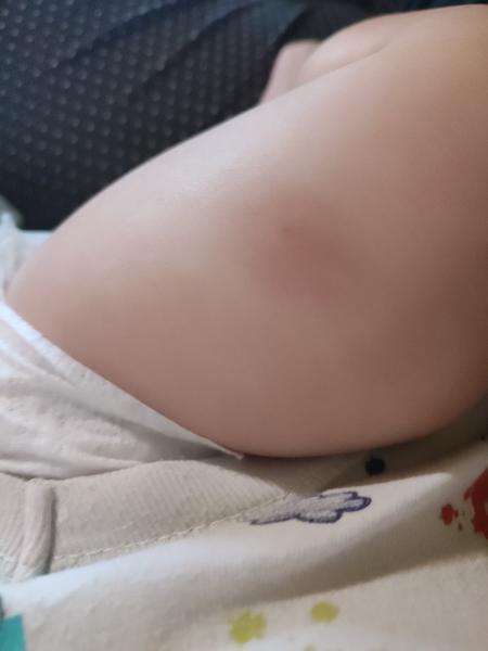 Reakce na očkování - červený otok a boule. Je to normální? Kdy to zmizí?