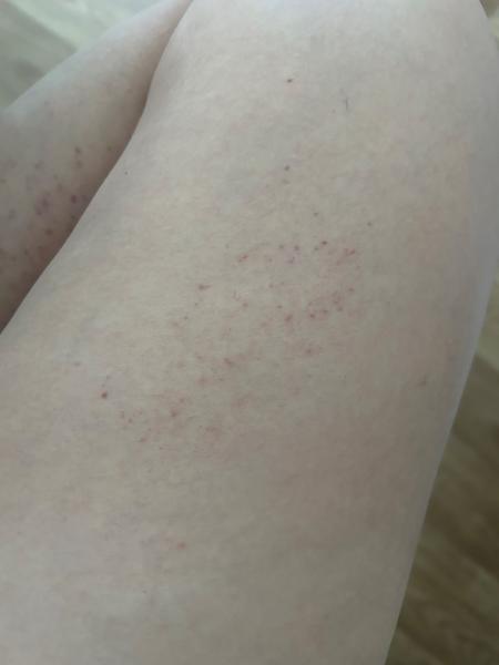 Nevíte, co způsobuje fialové svědivé pupínky na nohou?