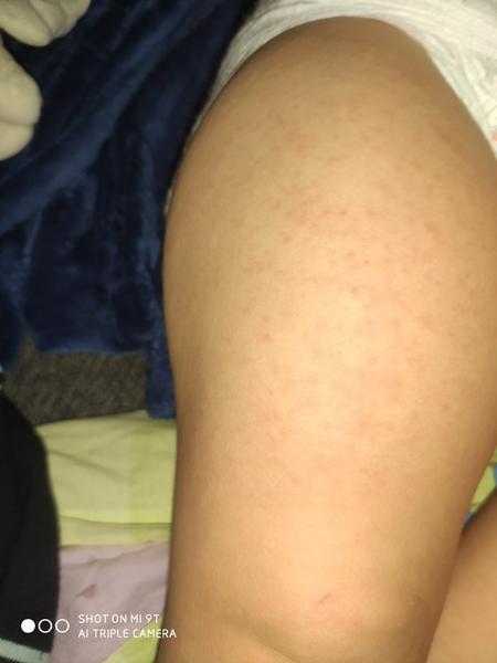 Šestá nemoc nebo spalničky - bojím se. Já měly Vaše děti vyrážky?