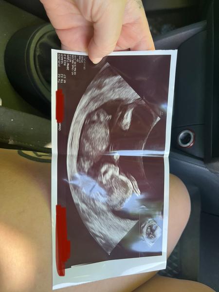 Růst pohlaví v 13. týdnu: Jak to vypadá na ultrazvuku?