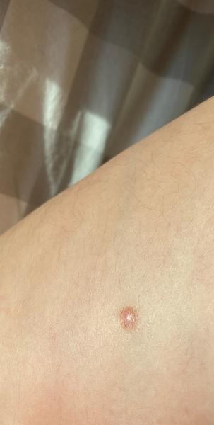 Odstranění kožního výrůstku na stehně. Máte zkušenost?