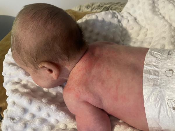 Červené flíčky po těle. Jde o novorozenecké akné?